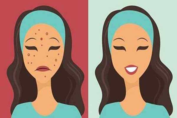 痘痘挤了之后怎么处理 痘痘挤了之后怎么处理