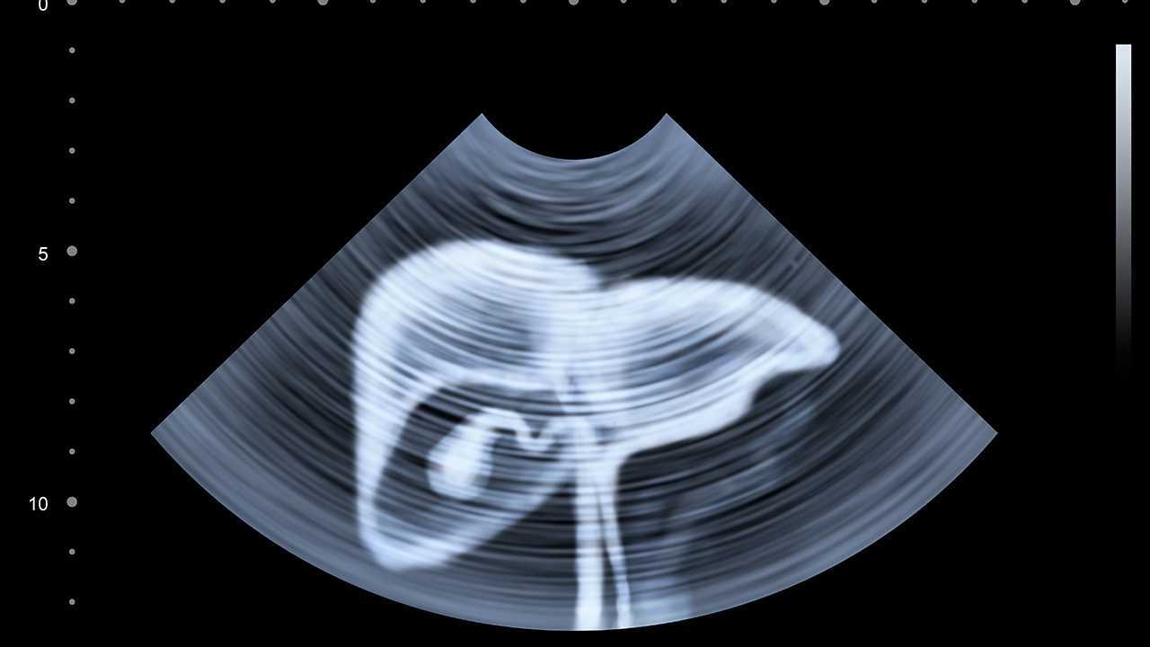 香蕉可以防止肠道出血吗？肝硬化的主要病因是什么？