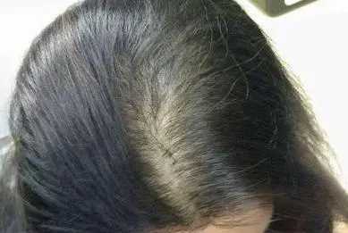 植发医院哪家最好 植发医院哪家最好