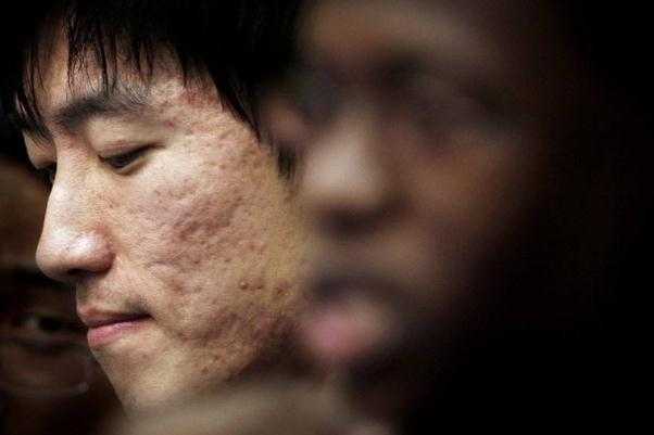 青春痘留下的疤痕怎么才能消除掉 青春痘留下的疤痕怎么才能消除掉