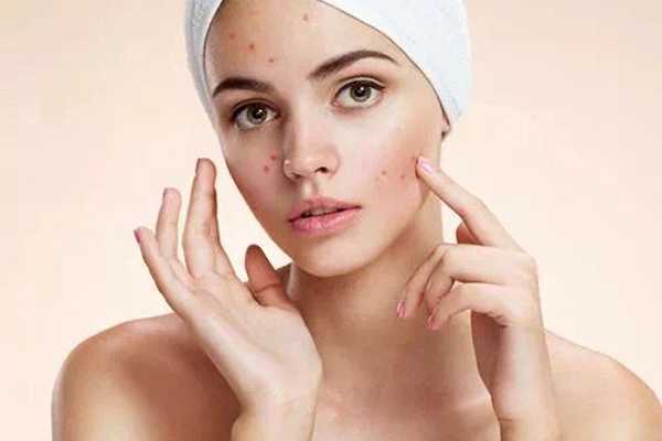 苏菲娜隔离痘痘肌可以用吗 苏菲娜隔离痘痘肌可以用吗