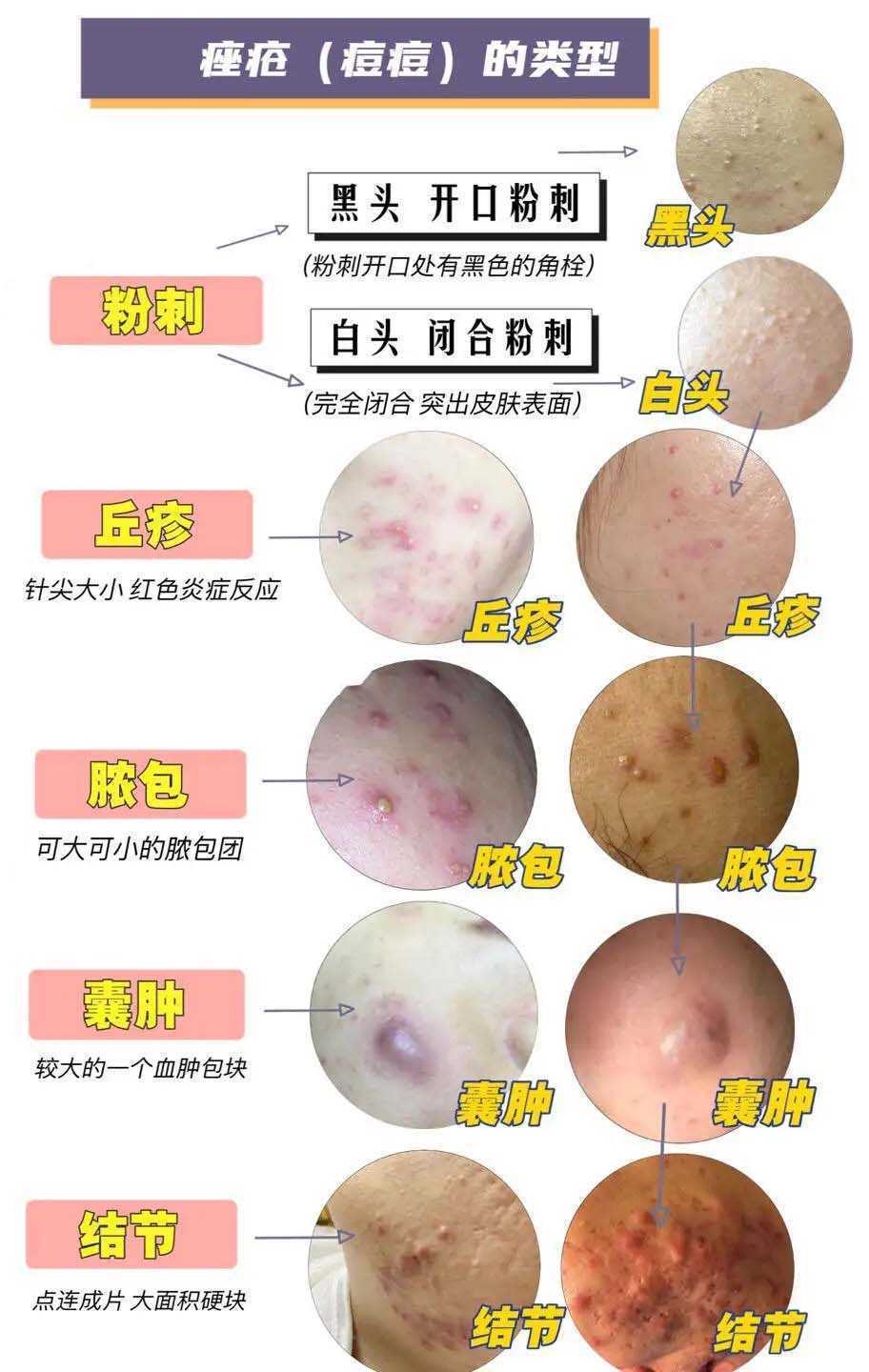 青春痘是什么样子的