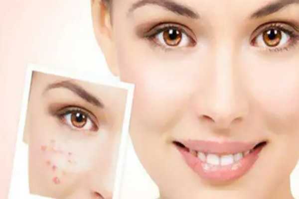 粉刺是怎么产生的?粉刺是什么样子 粉刺是怎么产生的?粉刺是什么样子