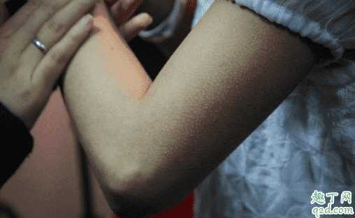 维a酸乳膏去鸡皮肤效果好吗 维a酸乳膏去鸡皮肤效果好吗