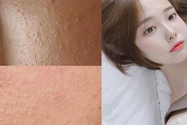 怎么区分脂肪粒和闭口