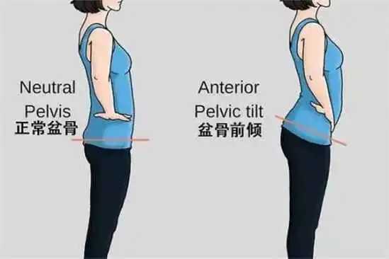 骨盆前倾能用日式整骨矫正吗 骨盆前倾能用日式整骨矫正吗