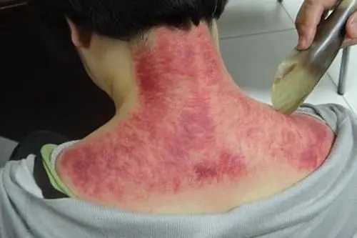 刮痧有什么好处和坏处？