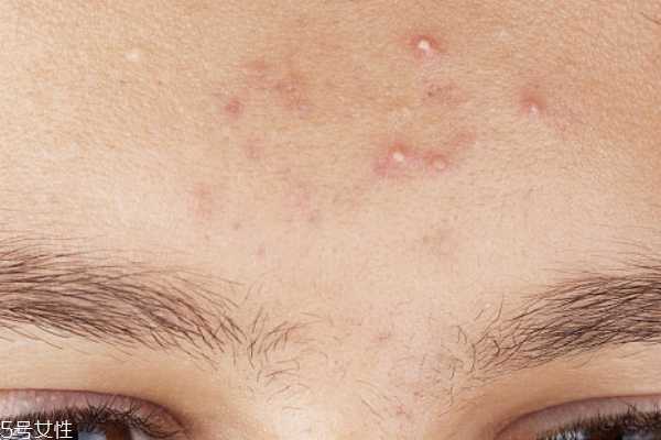 祛痘产品哪个好