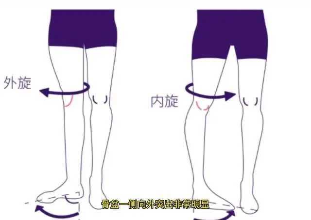 成人矫正o型腿最有效的动作图解 成人矫正o型腿最有效的动作图解