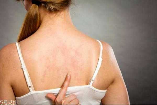 背上长痘痘怎么消除 背上长痘痘的原因和解决方法