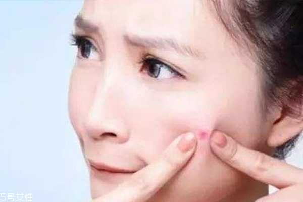 什么痘痘不能挤