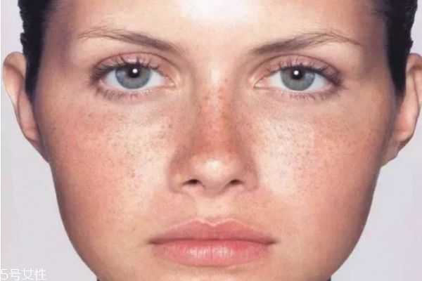 色斑的形成原因和去除方法