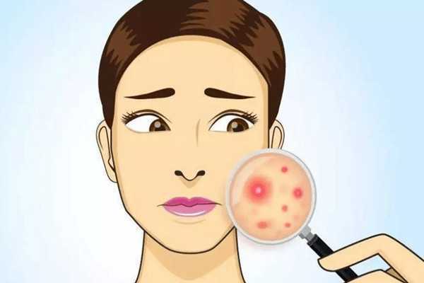 长痘痘能涂防晒霜吗 长痘痘能涂防晒霜吗