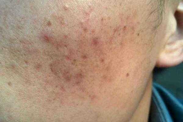 色素沉着能祛除吗？色素沉着怎么快速去除