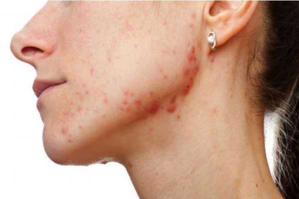 下巴上长痘痘是什么原因