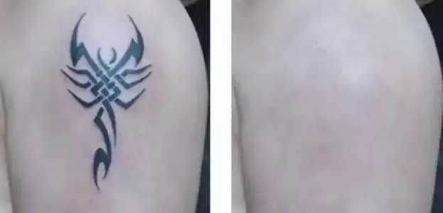 洗纹身的价格大概是多少 洗纹身的价格大概是多少