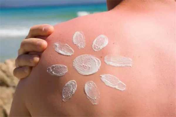 皮肤晒褪皮怎么办？皮肤晒过之后怎处理