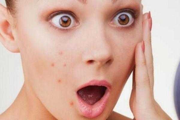 粉刺可以挑出来吗？粉刺可以自己挤吗