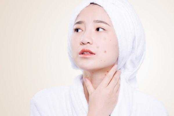 刷酸爆痘之后怎么办？刷酸可以祛痘印吗