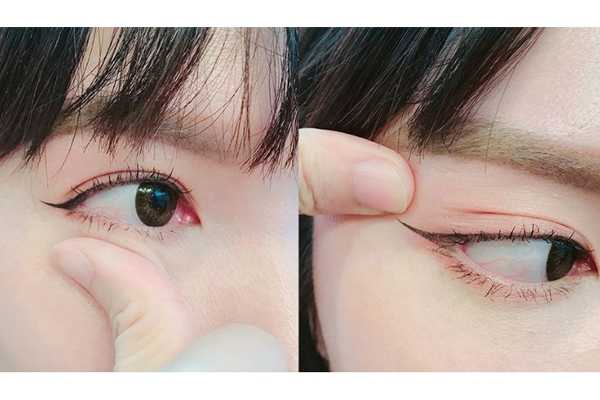 眼尾下垂怎么拯救