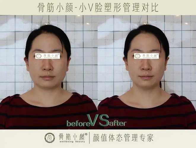 日式小颜会让脸变方吗 日式小颜会让脸变方吗
