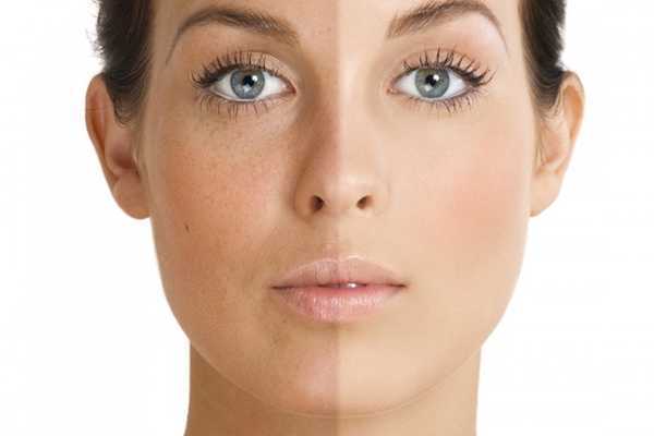 晒斑是如何形成的 晒斑是如何形成的