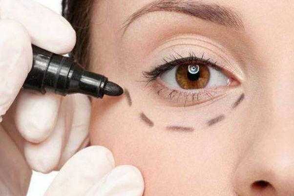 眼袋会不会遗传？眼袋能自然消除吗