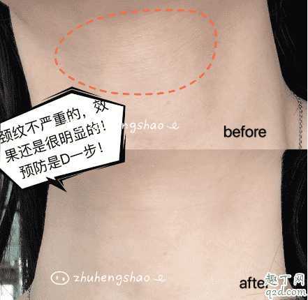 米加颈霜有没有效果