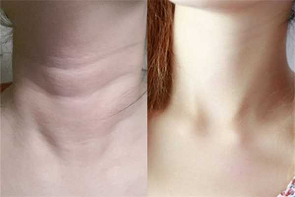颈纹是怎么引起的？颈纹怎么消除简单的方法
