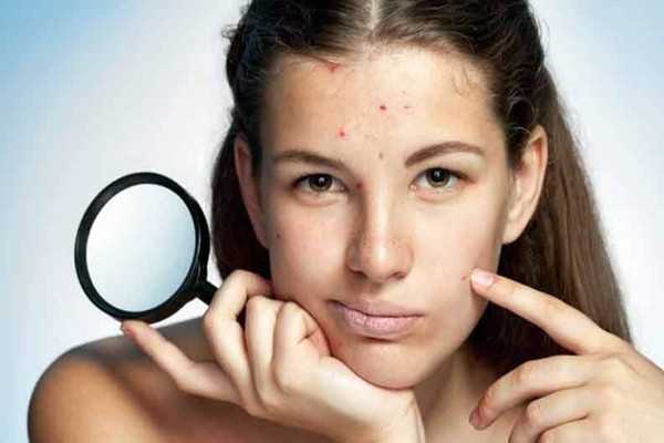 有粉刺可以化妆吗？有粉刺可以刷酸吗