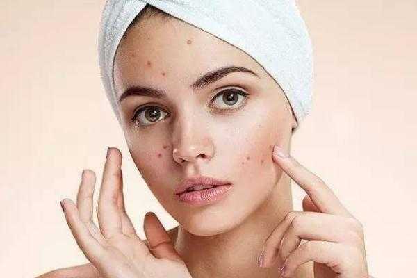 粉刺会留下痘印么?粉刺会长在哪些地方 粉刺会留下痘印么?粉刺会长在哪些地方