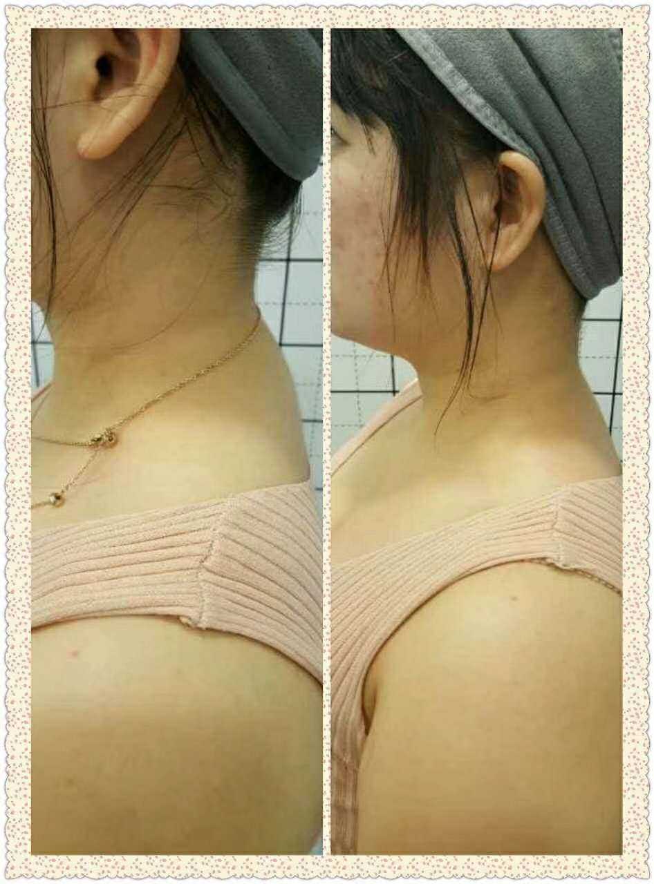 徒手整骨整形前后对比照片