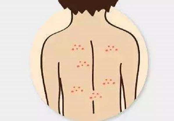 后背长痘痘是什么原因 后背长痘痘是什么原因