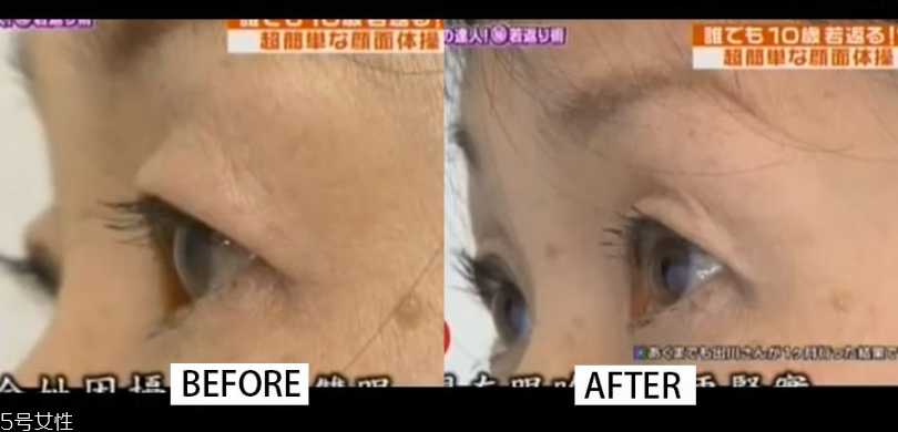 眼尾下垂怎么拯救