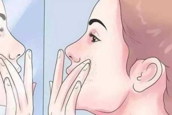 黄褐斑有几种类型？长在什么位置