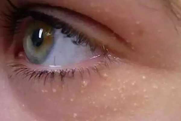 维生素E去脂肪粒步骤