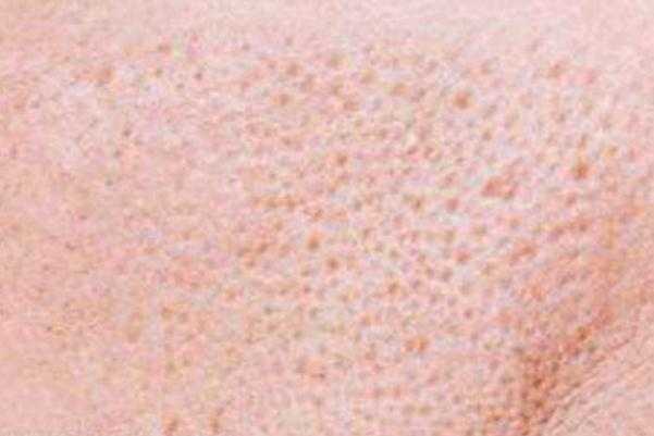 收缩毛孔可以用芦荟胶吗