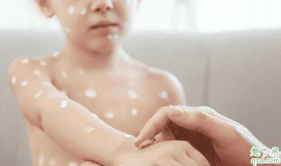 擦身体乳能不能去鸡皮?女生如何祛除身上的鸡皮 擦身体乳能不能去鸡皮?女生如何祛除身上的鸡皮