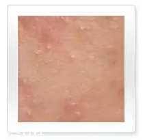 平衡露什么成分能祛痘