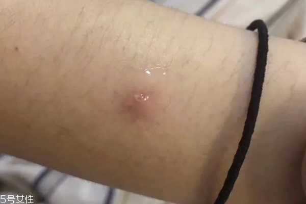 悦木之源祛痘凝胶刺痛什么原因