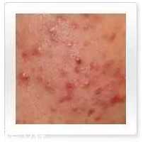 平衡露什么成分能祛痘