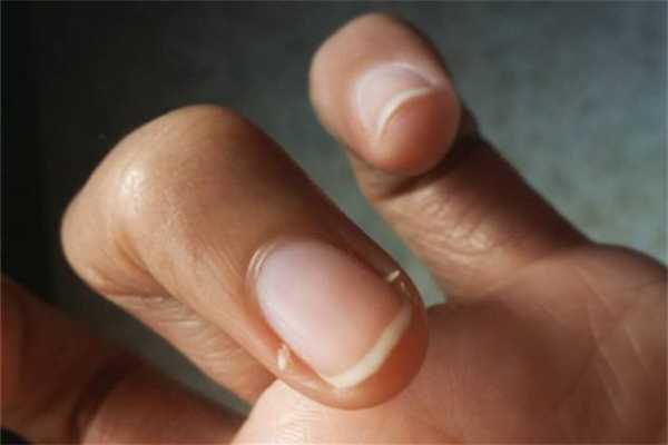 倒刺可以撕吗？倒刺拔了会怎么样？千万不能任性直接撕掉