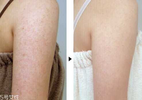 去鸡皮肤用什么好