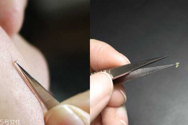 挤痘痘工具用什么好