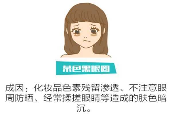如何分辨黑眼圈类型