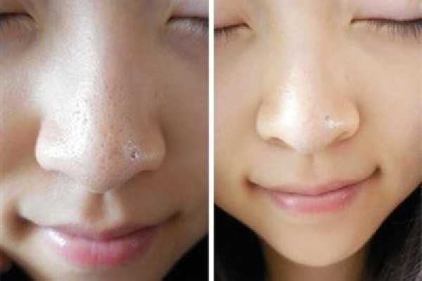 去黑头后可以用爽肤水收缩毛孔吗 去黑头后可以用爽肤水收缩毛孔吗