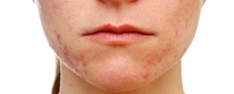 祛痘痘的小方法 祛痘痘的小方法