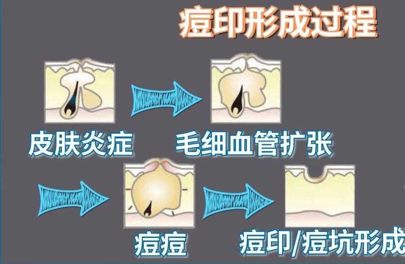 如何科学有效地祛痘印呢 如何科学有效地祛痘印呢