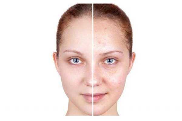 粉刺是怎么产生的?粉刺是什么样子 粉刺是怎么产生的?粉刺是什么样子