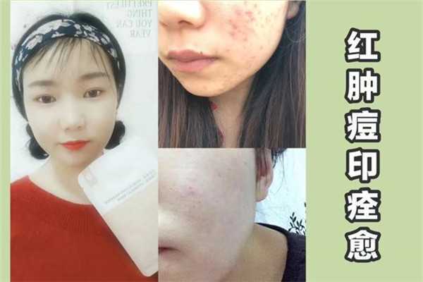 我的皮肤老是长痘痘是什么原因呢